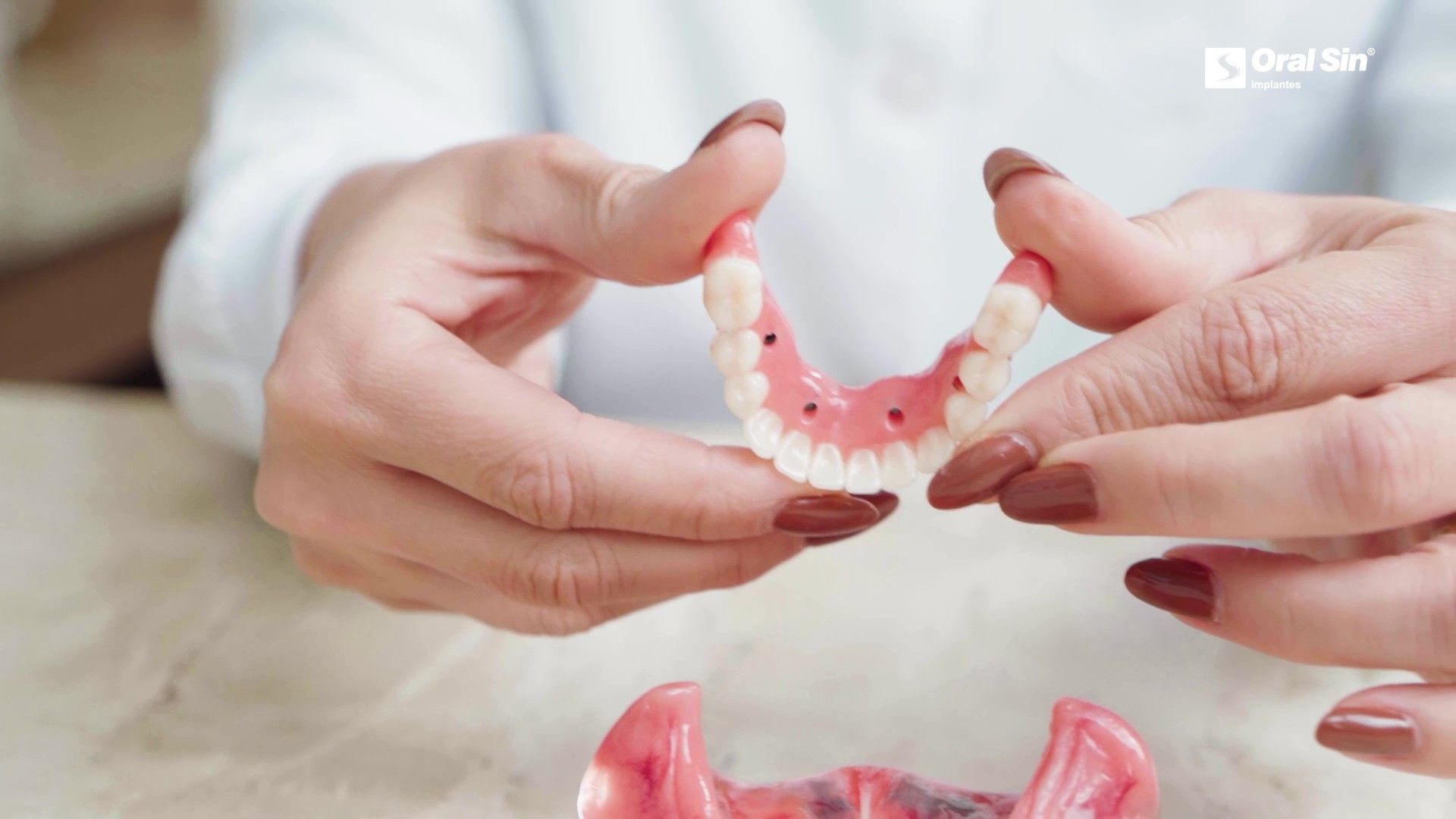 Implantes dentários: o que são e quais os tipos?