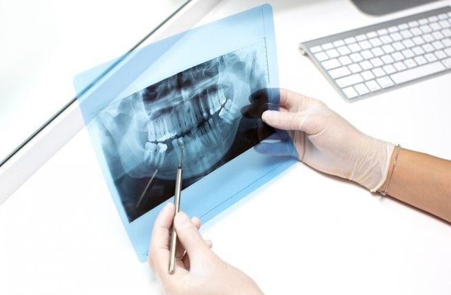 Perda óssea dentária: como tratar e prevenir?