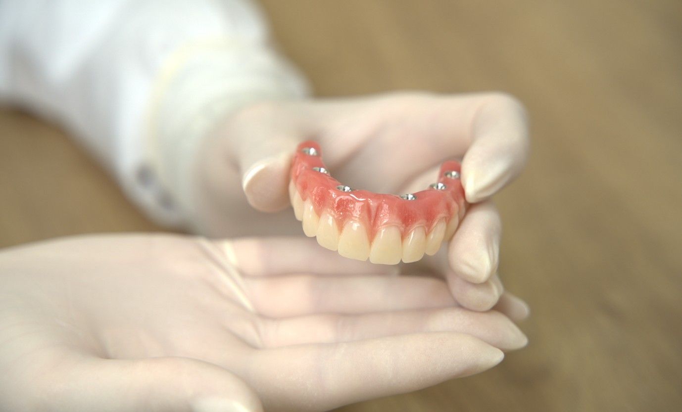 Implante dentário: o que é e quais os tipos?