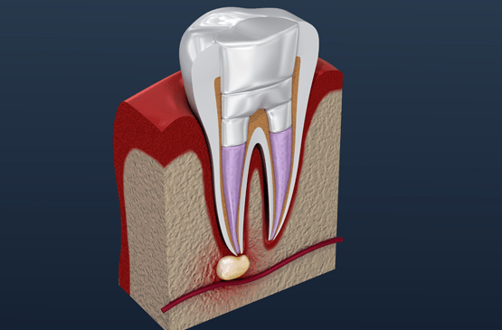 Tooth Fillings — Illustration of Tooth Fillings in Gainesville, GA