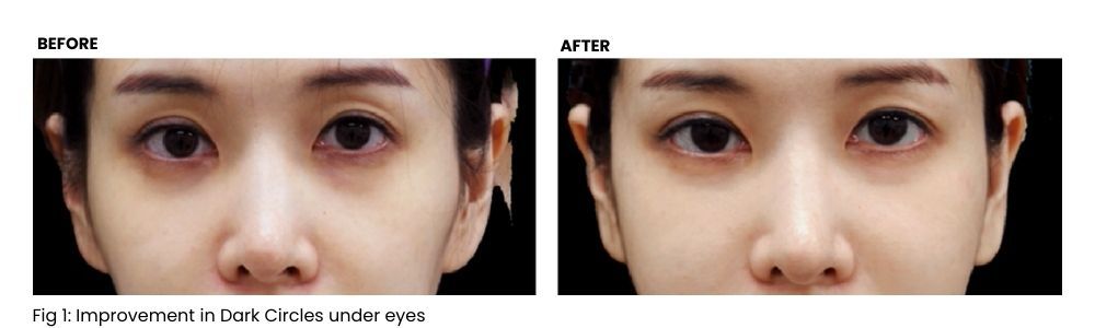 Before and after comparison of dark circles under the eyes. The 'after' photo shows improved appearance.