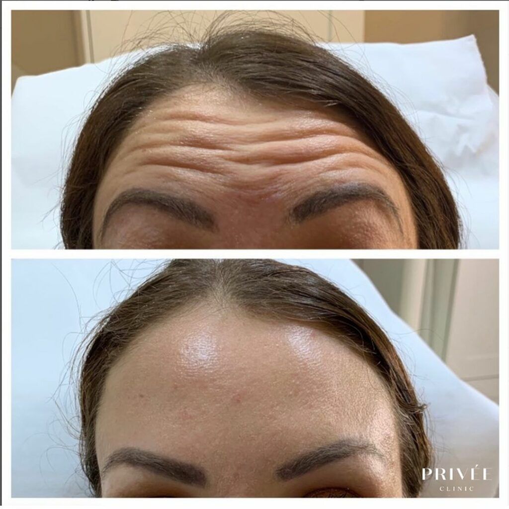 Forehead with wrinkles before and after treatment, smoother appearance post-treatment.