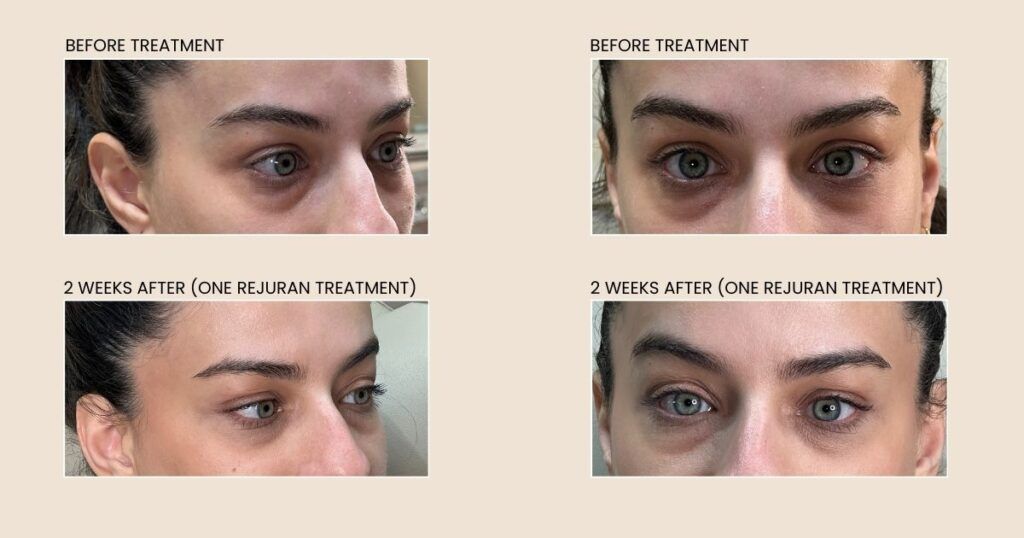 Four images comparing under-eye appearance before and after treatment, showing a reduction in dark circles.