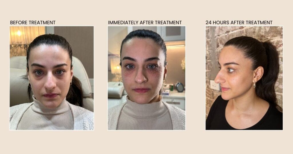 Before-and-after photos: frontal and profile views of a woman's face showing rhinoplasty results.