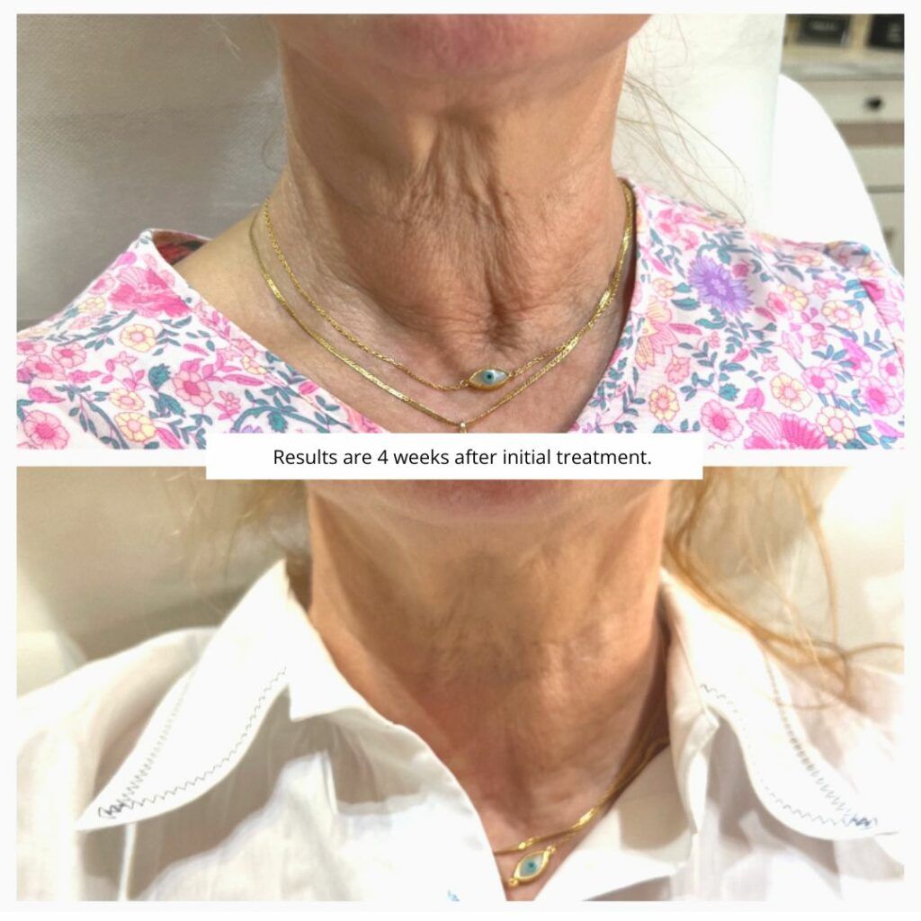 Before and after comparison of neck skin; wrinkles reduced four weeks post-treatment.