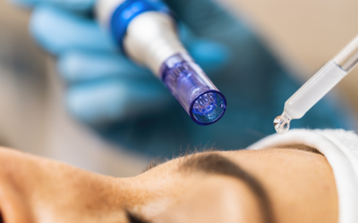 What is Microneedling and Is It Worth All the Hype?