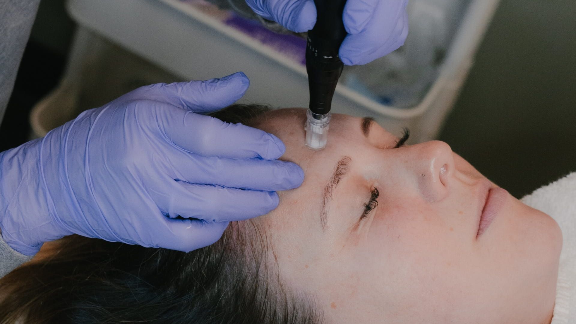 Microneedling Patient Receives Treatment
