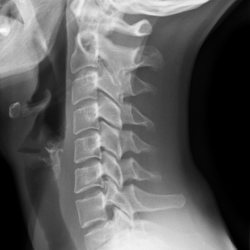 chiropractic x-ray of neck