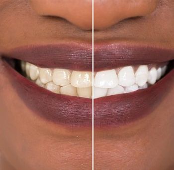 Cosmetic Teeth Result — Newburyport, MA — Vaka Dental Care