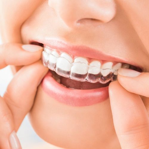 Putting Invisalign Braces — Newburyport, MA — Vaka Dental Care