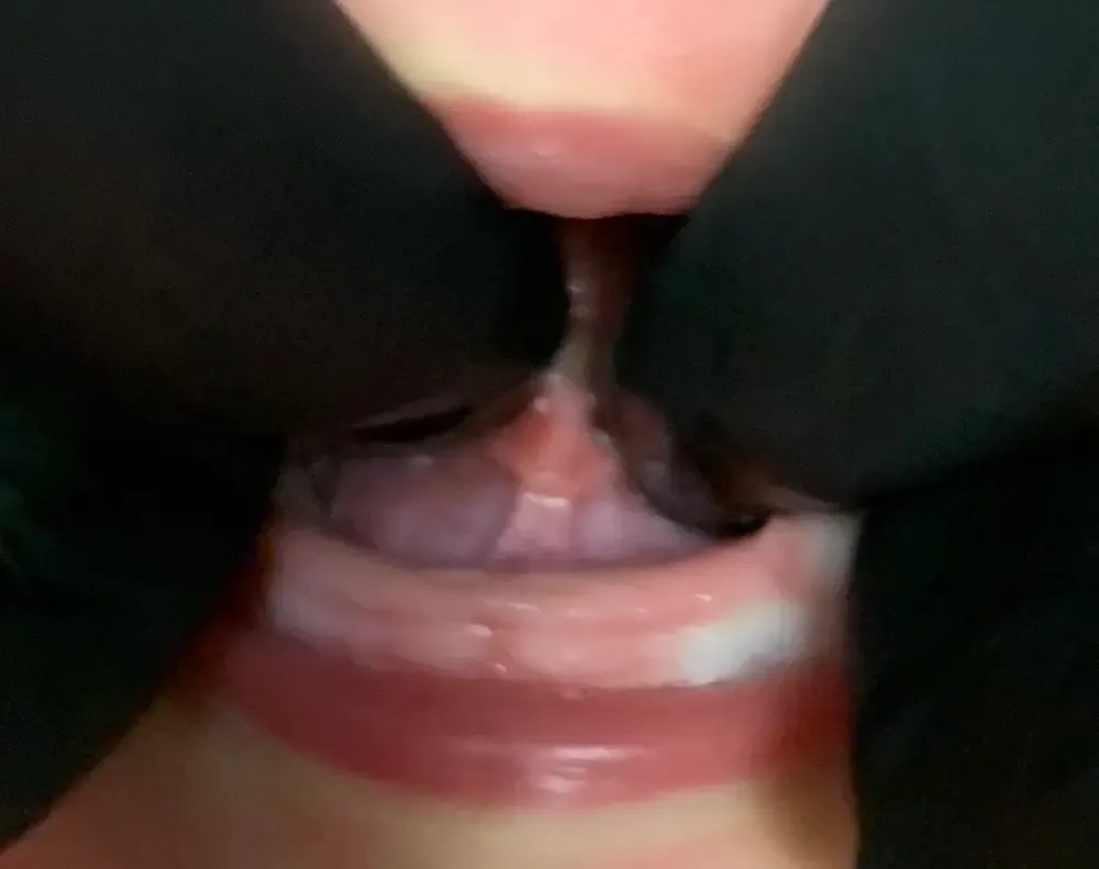 Healing After 10 Days | Tongue tie release from same day pediatric dentist in Marrero LA