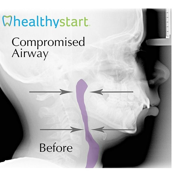 HealthyStart Systems Before and After | Pediatric Dentistry in Marrero LA