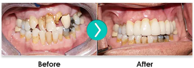 Before And After 6 Month Smiles Teeth