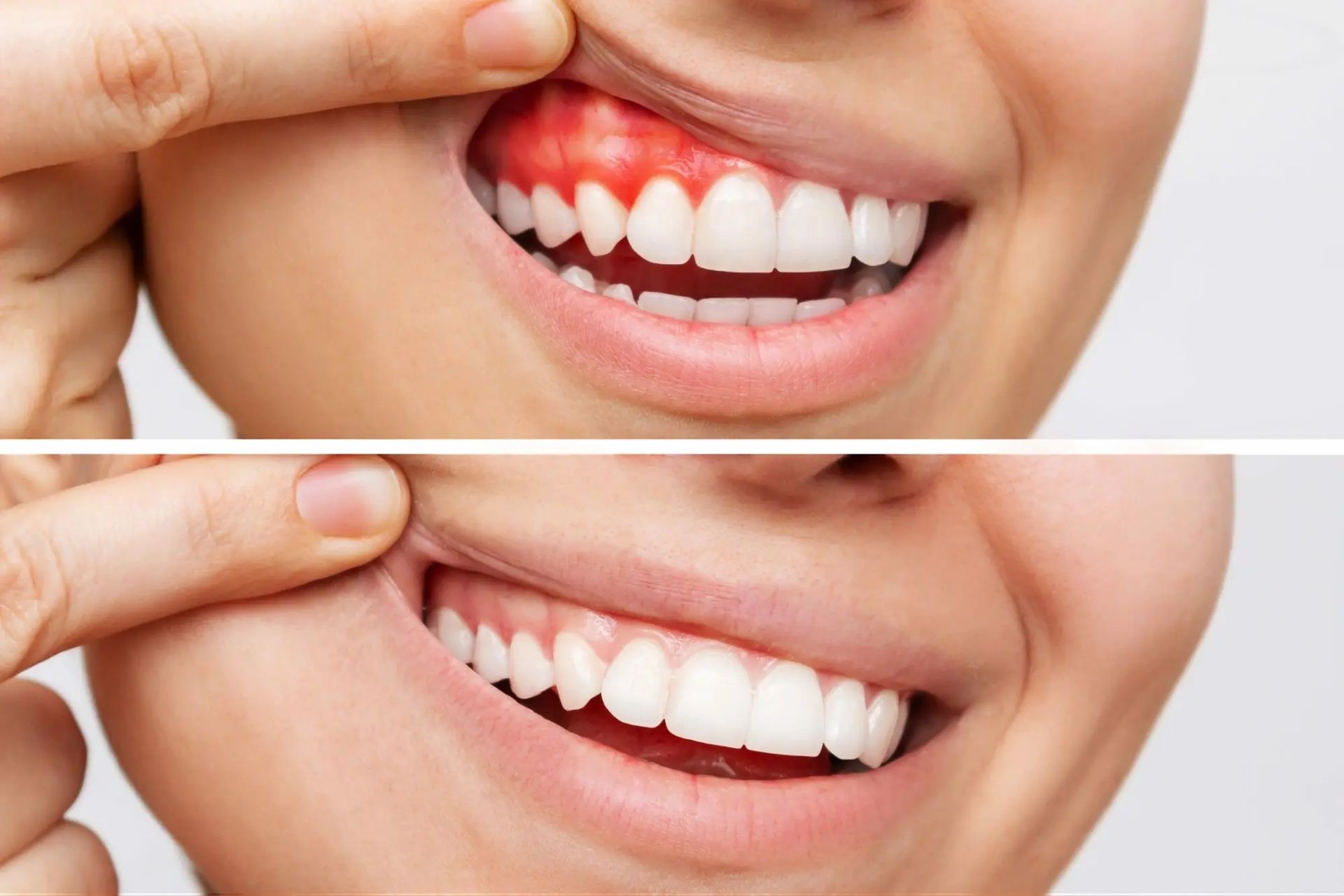 A before and after picture of a woman 's teeth.