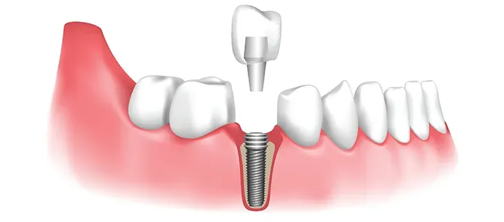 A dental implant is sitting in the middle of a row of teeth.