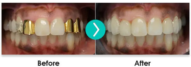 Before And After 6 Month Smiles Teeth