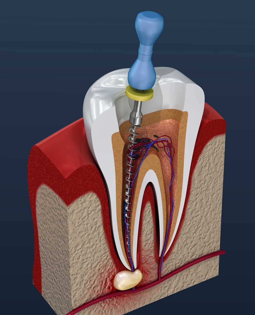 A model of a tooth with a drill in it