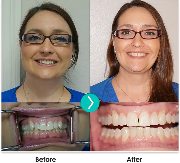 Before And After 6 Month Smiles Photo