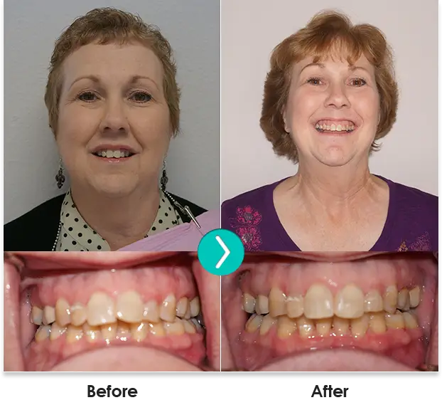 Before and After 6 Month Smiles Photo