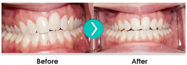 Before And After 6 Month Smiles Teeth