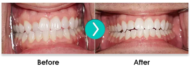 Before And After 6 Month Smiles Teeth