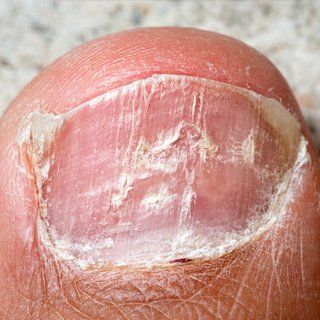 cracked toe nail treatment