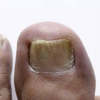 treatment for foot fungus