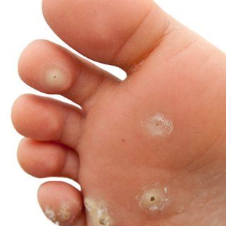 nail infection on the foot