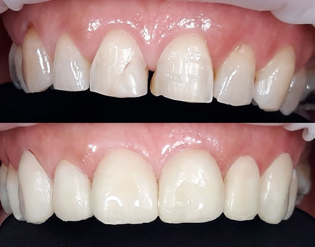 In de bovenste rij zijn de voortanden afgebroken, in de onderste rij zijn dezelfde tanden gerepareerd.