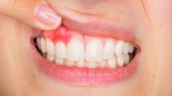 De mond van de persoon heeft ontstoken, rood tandvlees bij de tanden. De vinger tilt de lip op om deze te laten zien.