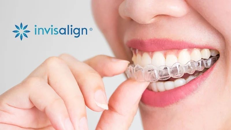Persoon die een transparante Invisalign-aligner over de tanden plaatst.