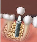 Schematische weergave van een implantaat: een schroef in de kaak die een kroon ondersteunt.