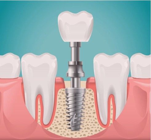 Diagram van een tandheelkundig implantaat: een titanium staafje dat in het kaakbot wordt geplaatst, met daarop een tandkroon.