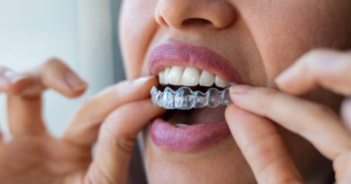 Persoon die transparante aligners in de mond inbrengt.