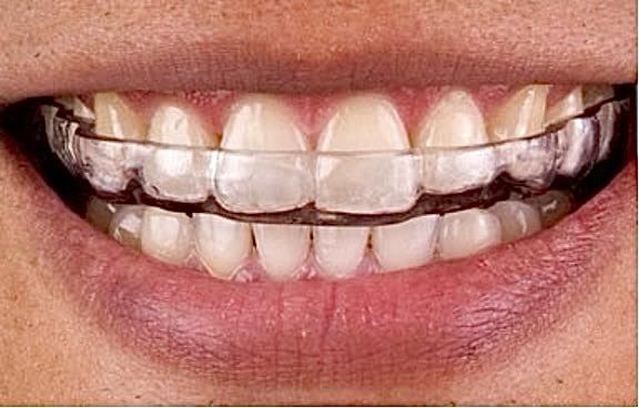 Close-up van de mond van een persoon met een doorzichtige plastic beugel, waardoor de tanden zichtbaar zijn.