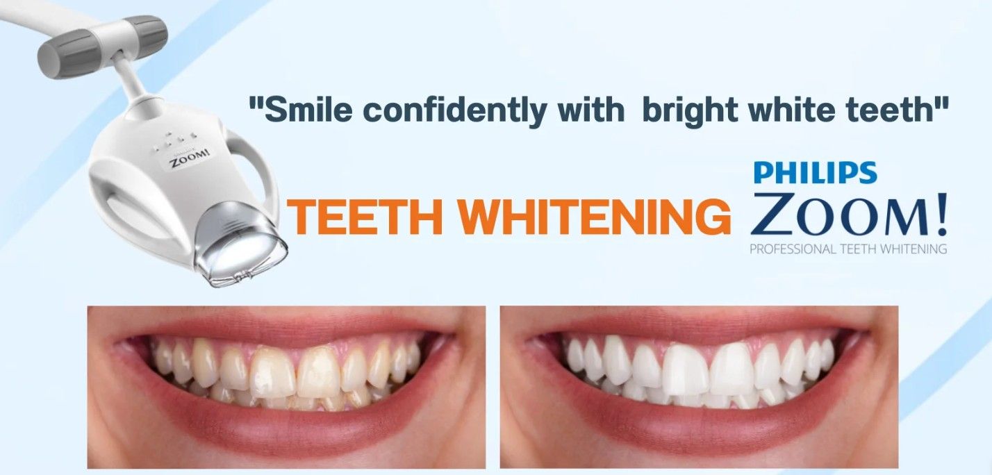 Reclame voor tandenbleken: vergelijking van stralende tanden voor en na met het Philips Zoom-apparaat.