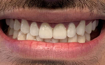 A close up of a man 's teeth with a beard.