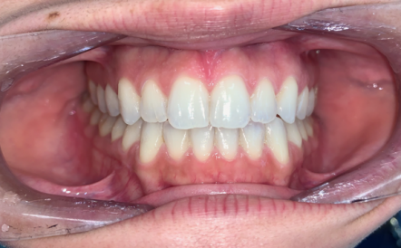 A close up of a person 's mouth with white teeth.