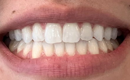 A close up of a person 's teeth with white teeth.