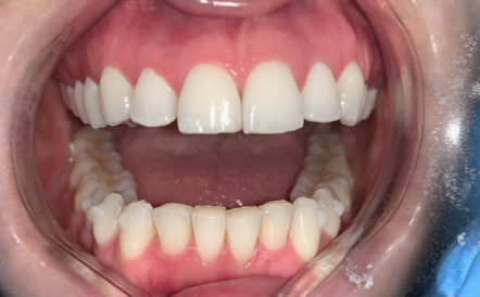 A close up of a person 's teeth with white teeth.