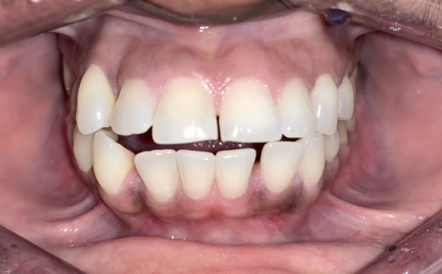 A close up of a person 's teeth and mouth.