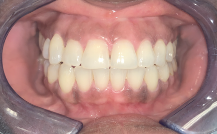 A close up of a person 's teeth with a mouth guard.