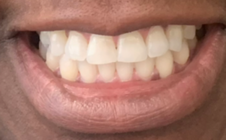 A close up of a person 's mouth with white teeth.