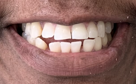 A close up of a man 's mouth with white teeth.