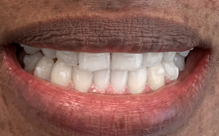 A close up of a person 's mouth with white teeth.