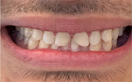 A close up of a man 's teeth with a beard.