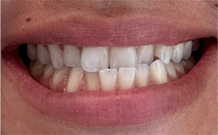 A close up of a person 's mouth with white teeth.