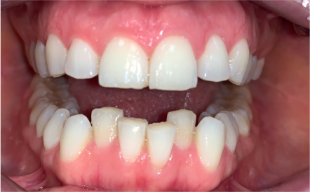 A close up of a person 's teeth with a missing tooth.