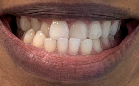 A close up of a person 's mouth with white teeth.