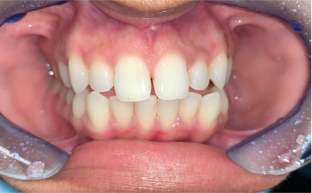A close up of a person 's teeth with a mouth guard.